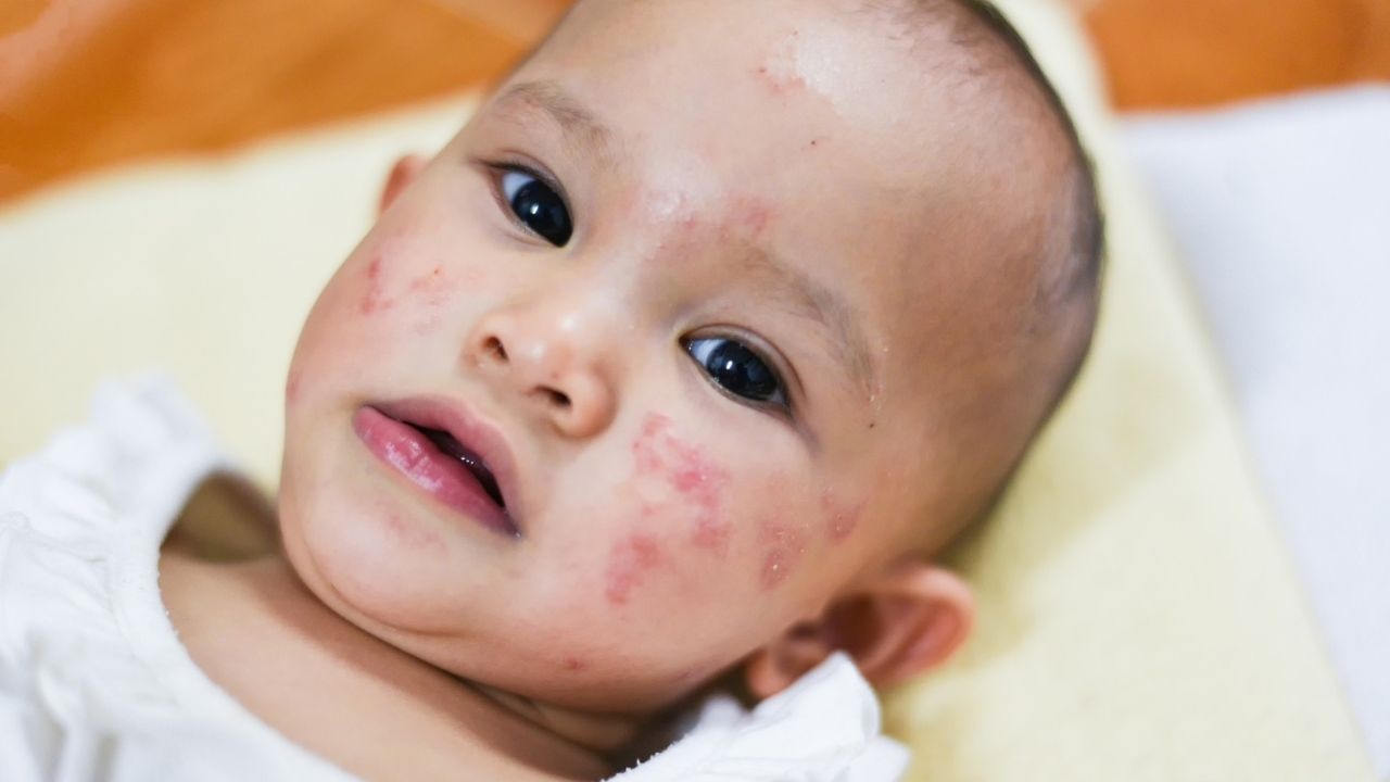 Piata choroba (rukynohyústa) u detí Ako sa toto ochorenie prejavuje