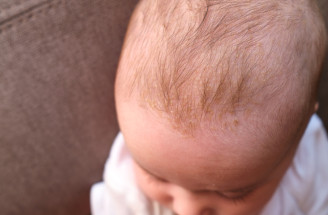 Mliečna chrasta u bábätka: Prečo vzniká a čo na ňu naozaj zaberá?