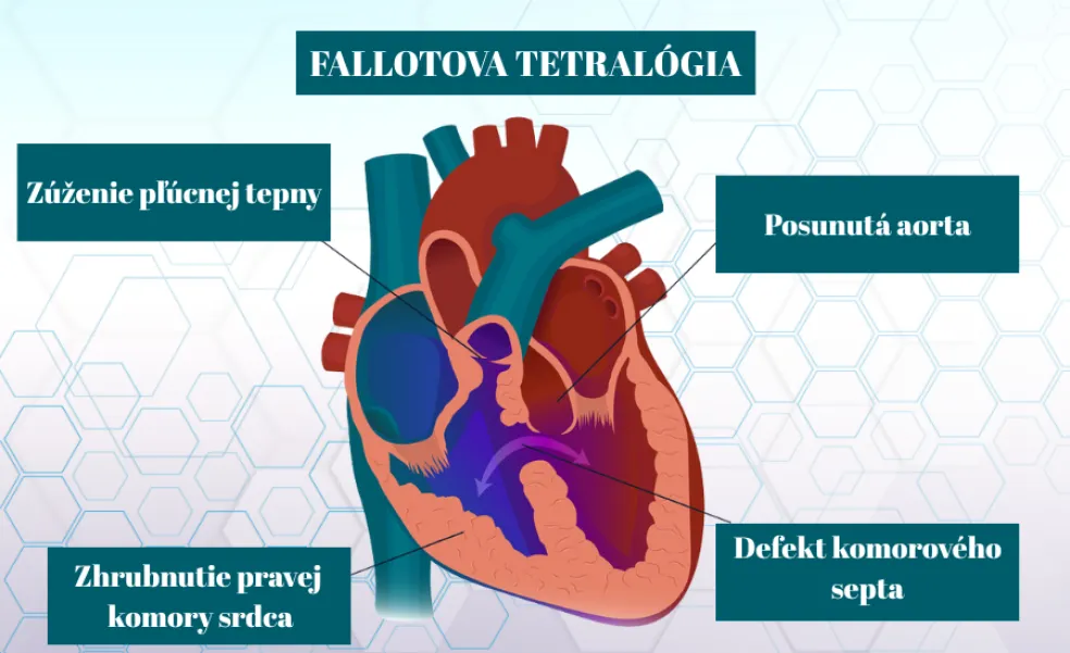 príznaky Fallotovej tetralógie