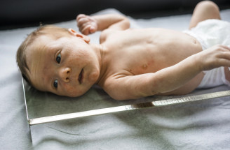 Neonatálny herpes: Príznaky, prenos a liečba novorodeneckého herpetického vírusu