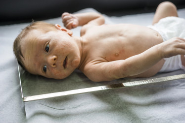 Neonatálny herpes: Príznaky, prenos a liečba novorodeneckého herpetického vírusu