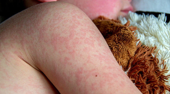 Osýpky stále hrozia – ako ochrániť svoje dieťa pred týmto ochorením?