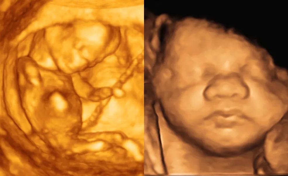 Priebeh 3D/4D ultrazvukového vyšetrenia