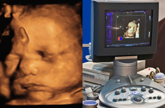 Chystáte sa na 3D/4D ultrazvuk? Toto všetko je dobré vedieť vopred!