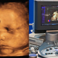 Chystáte sa na 3D/4D ultrazvuk? Toto všetko je dobré vedieť vopred!