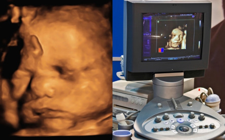 3D ultrazvuk 4D ultrazvuk