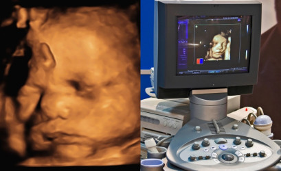 Chystáte sa na 3D/4D ultrazvuk? Toto všetko je dobré vedieť vopred!