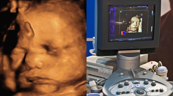 Chystáte sa na 3D/4D ultrazvuk? Toto všetko je dobré vedieť vopred!