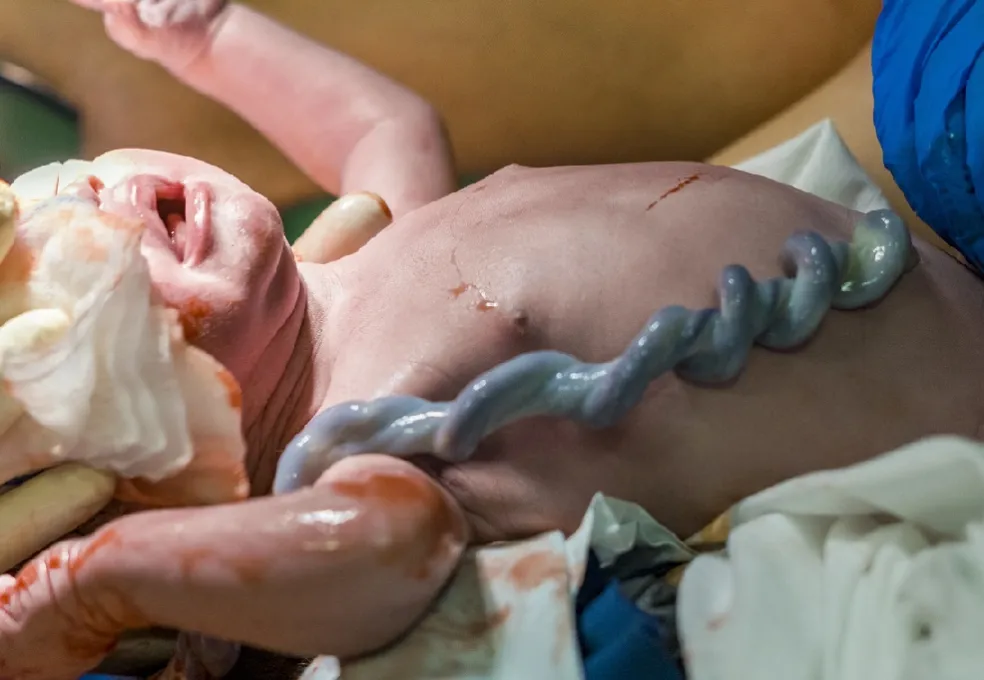 strihanie pupočnej šnúry