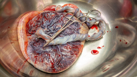 Placenta a jej komplikácie. Kedy je nutný chirurgický zákrok?