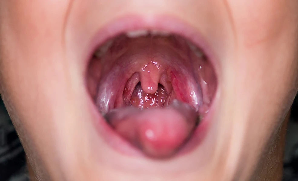 zápal mandlí angína