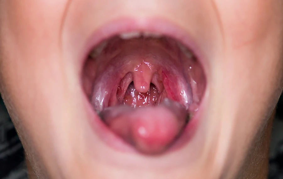 zápal mandlí angína