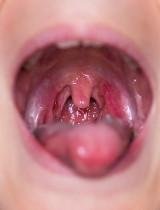 Zápal mandlí u dieťaťa – aké príznaky má angína a ako ju zvládnuť