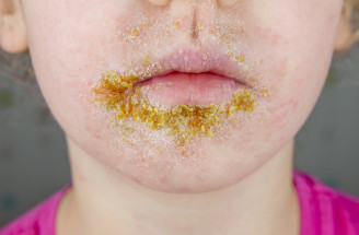 Impetigo u detí: Časté kožné ochorenie, ktorého sa netreba báť, no treba ho riešiť