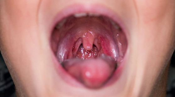 Zápal mandlí u dieťaťa – aké príznaky má angína a ako ju zvládnuť