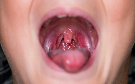 zápal mandlí angína